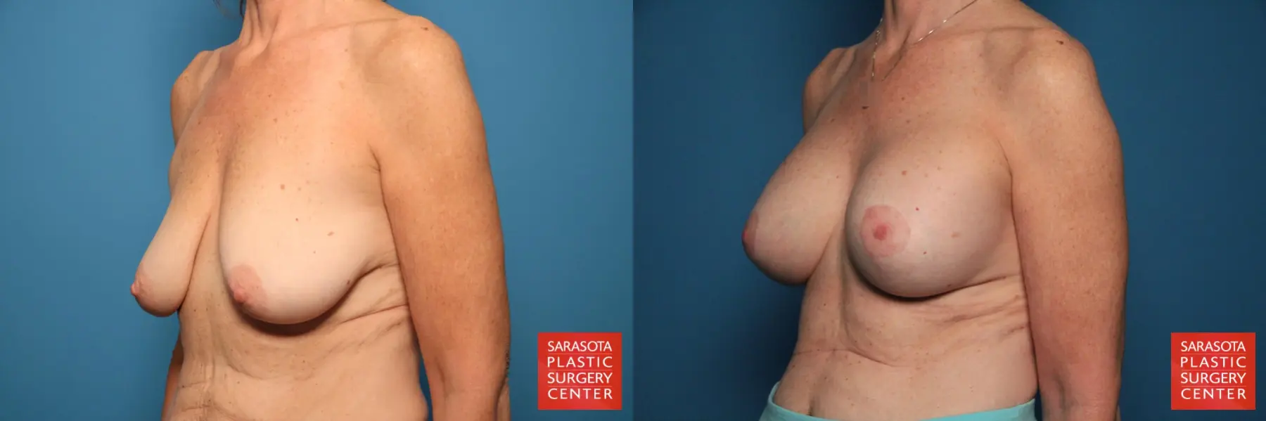 Breast Augmentation With Mesh : Patient 1 - Before and After 2