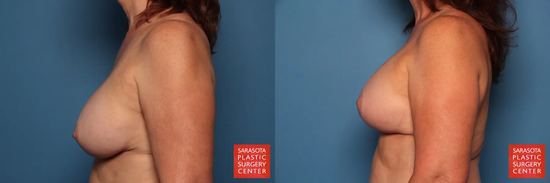 Breast Augmentation With Mesh : Patient 5 - Before and After 3