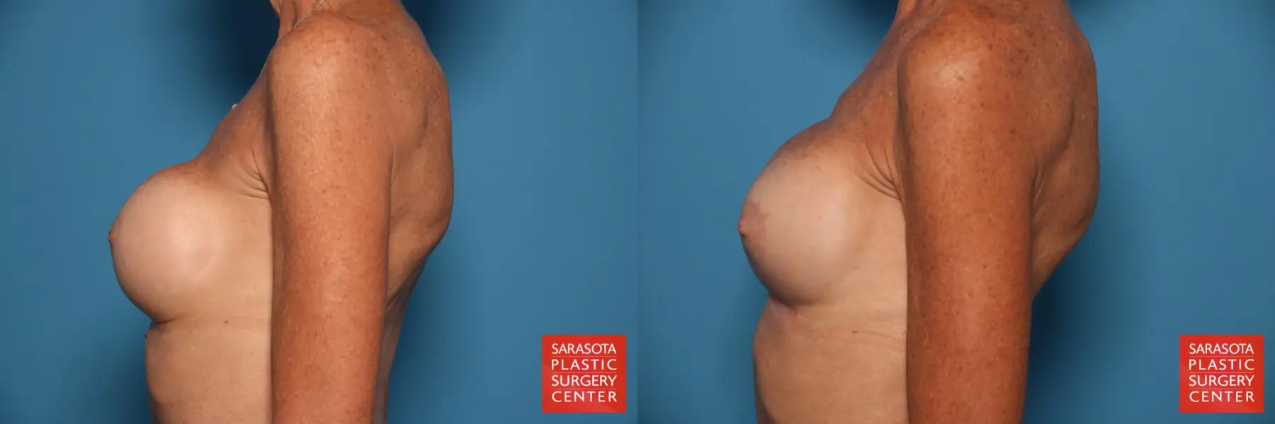 Breast Augmentation With Mesh : Patient 15 - Before and After 3
