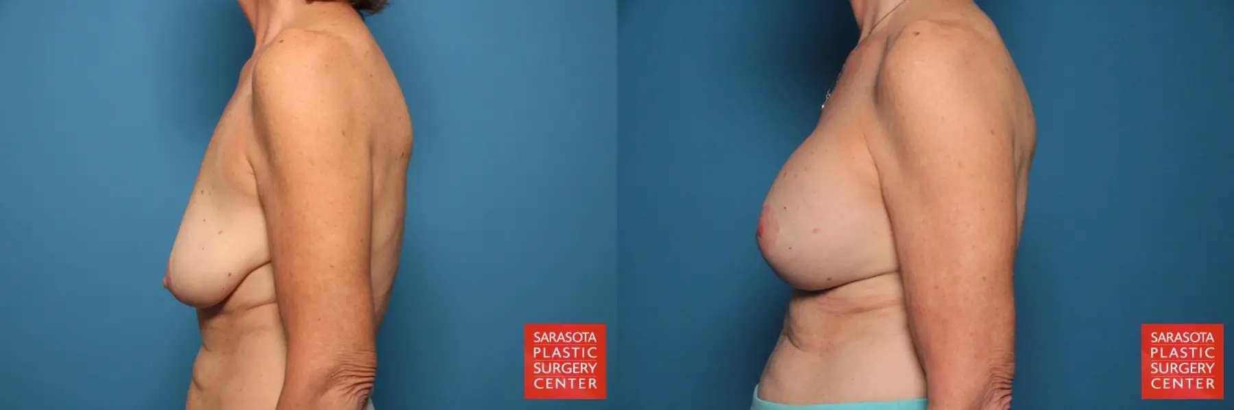 Breast Augmentation With Mesh : Patient 1 - Before and After 3