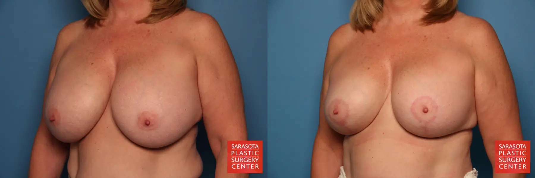 Breast Implant Exchange: Patient 16 - Before and After 2
