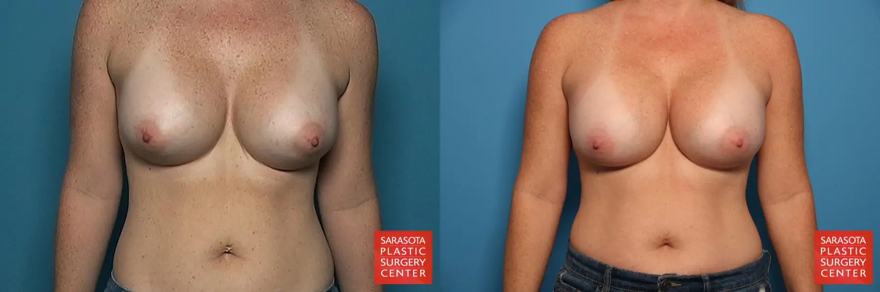 Breast Implant Exchange: Patient 3 - Before and After 1