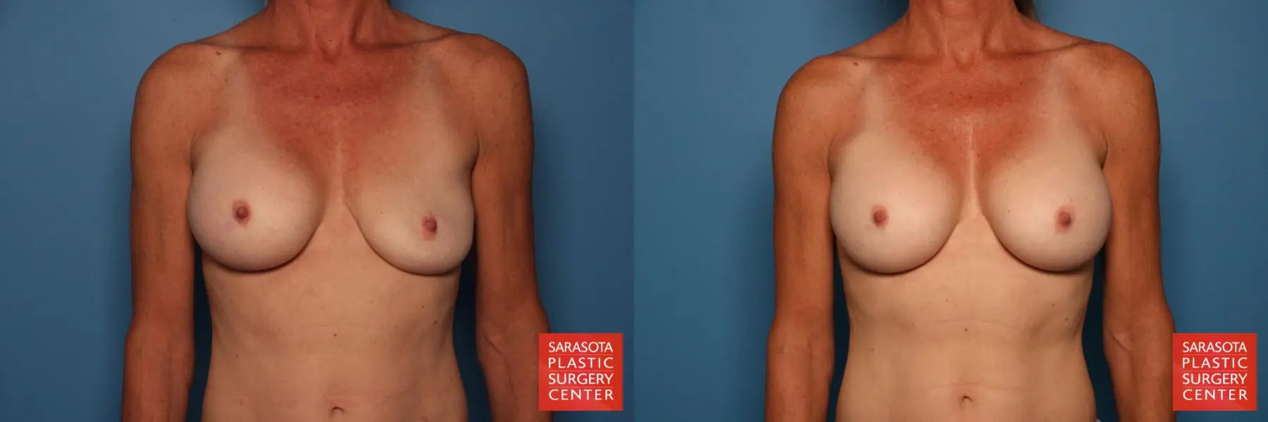 Breast Implant Exchange: Patient 11 - Before and After  