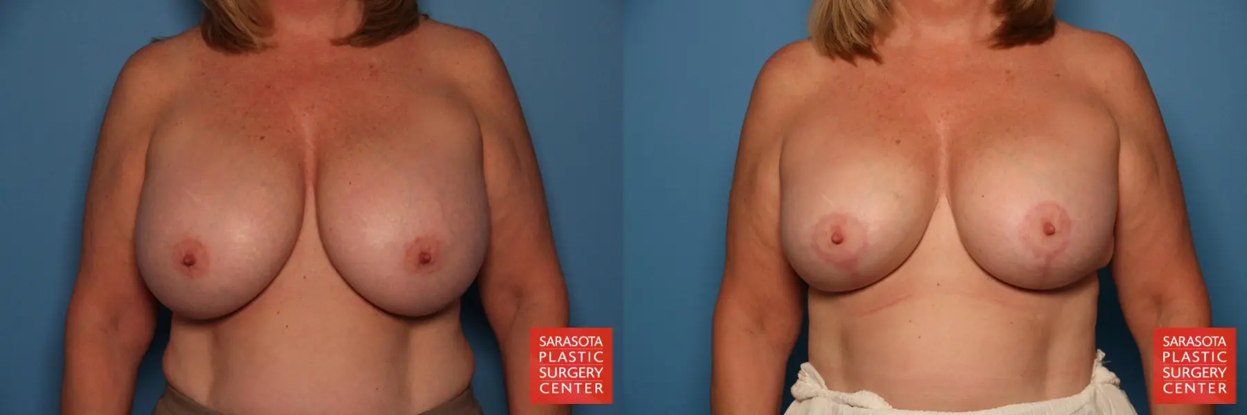 Breast Implant Exchange: Patient 16 - Before and After 1