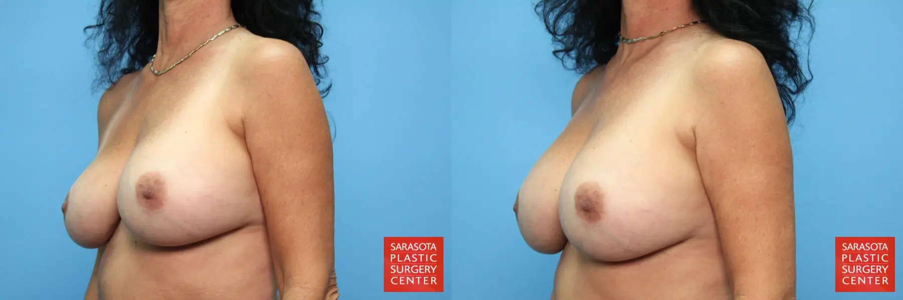 Breast Implant Exchange: Patient 17 - Before and After 2