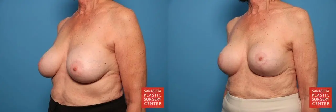 Breast Implant Exchange: Patient 20 - Before and After 2