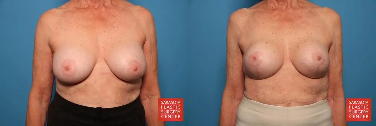 Breast Implant Exchange: Patient 20 - Before and After 1