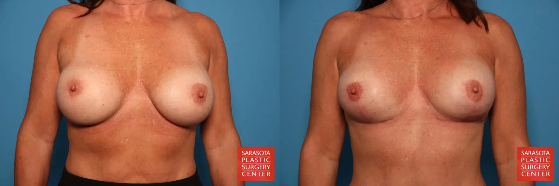 Breast Implant Exchange: Patient 5 - Before and After  