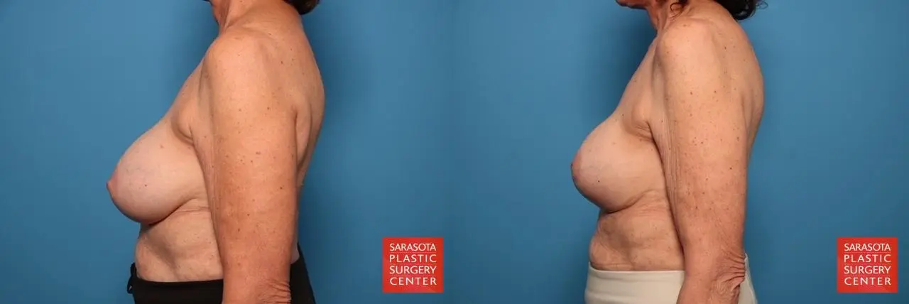 Breast Implant Exchange: Patient 20 - Before and After 3