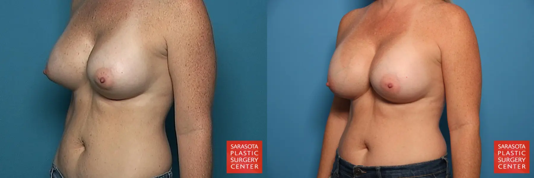 Breast Implant Exchange: Patient 3 - Before and After 2