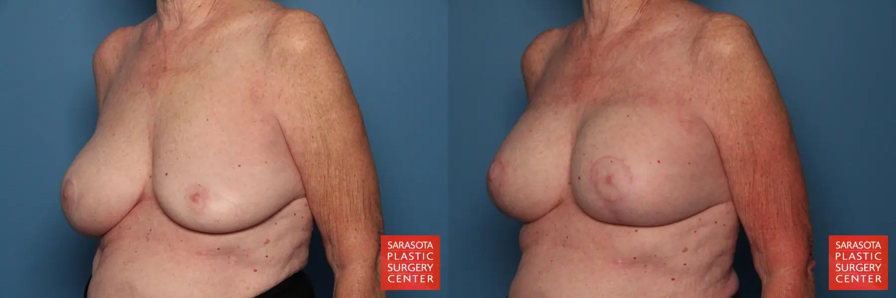 Breast Implant Exchange: Patient 7 - Before and After 2