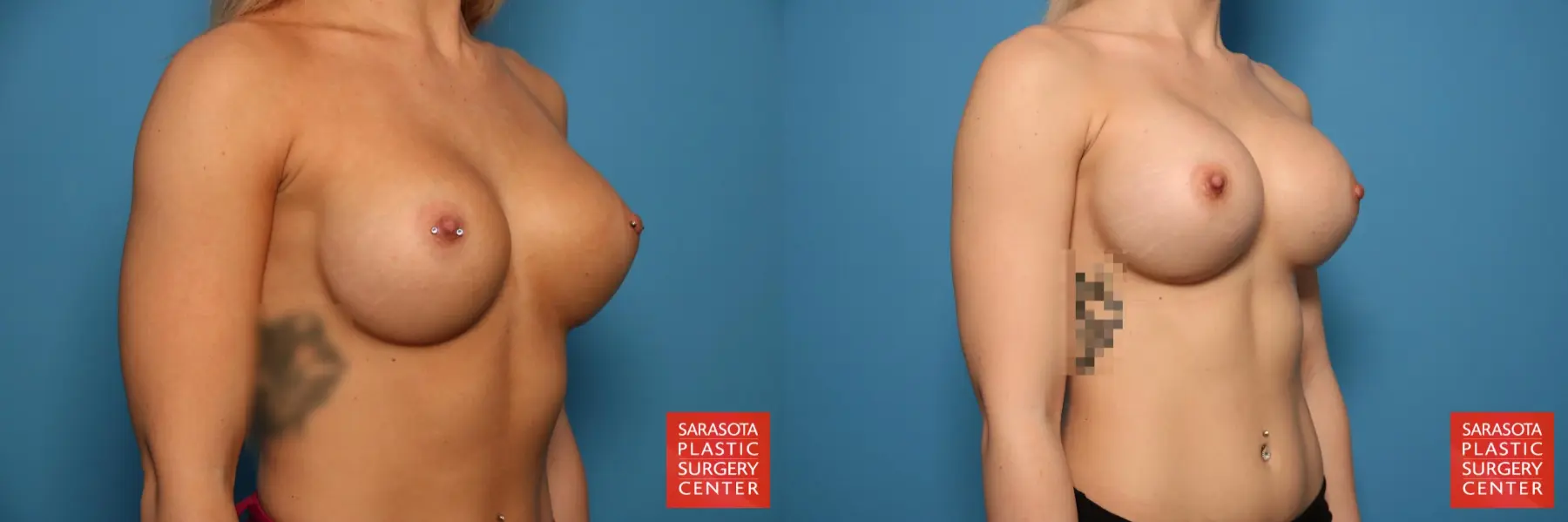 Breast Implant Exchange: Patient 18 - Before and After 2