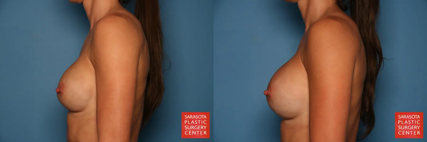 Breast Implant Exchange: Patient 1 - Before and After 3