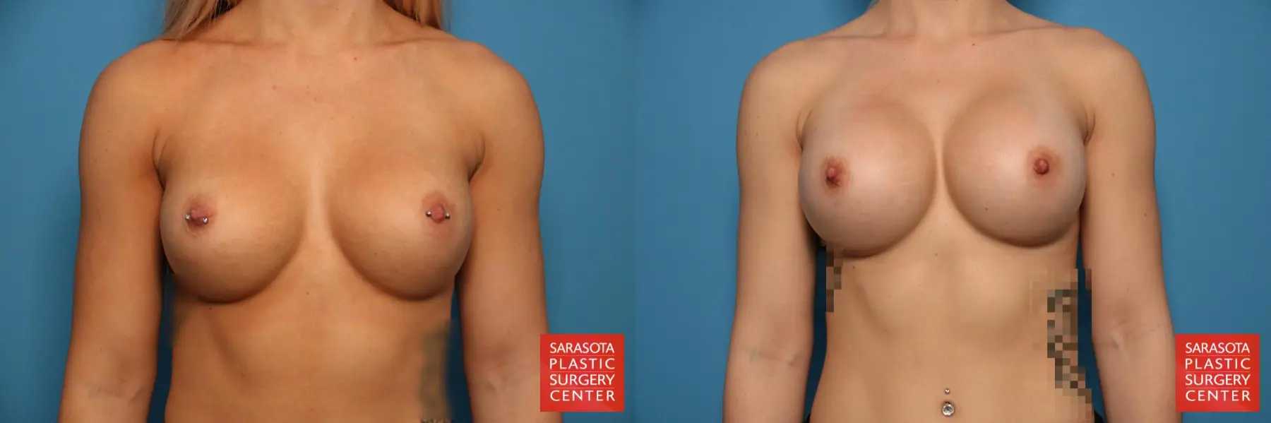 Breast Implant Exchange: Patient 18 - Before and After 1