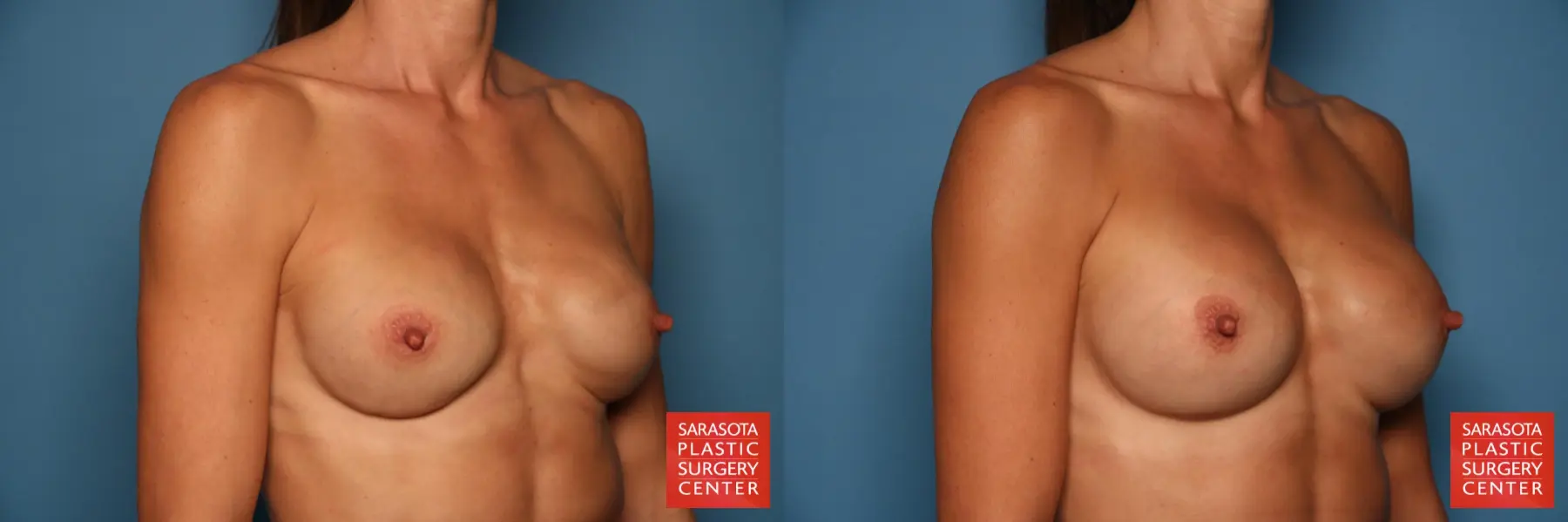 Breast Implant Exchange: Patient 1 - Before and After 4