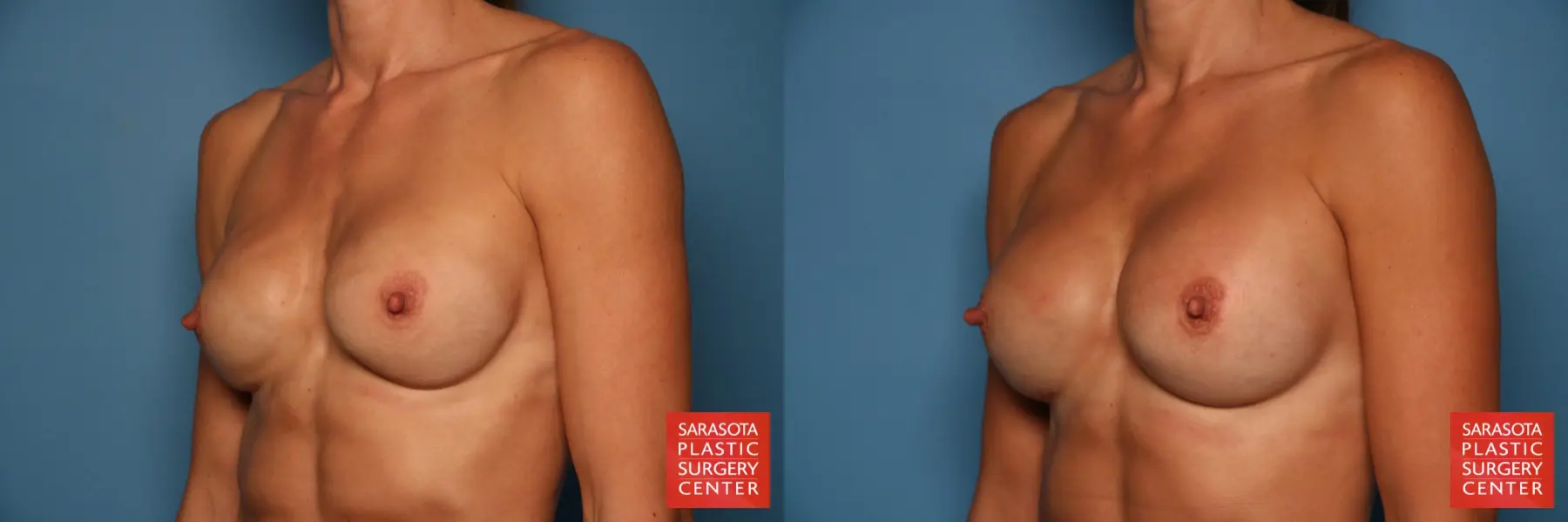 Breast Implant Exchange: Patient 1 - Before and After 2