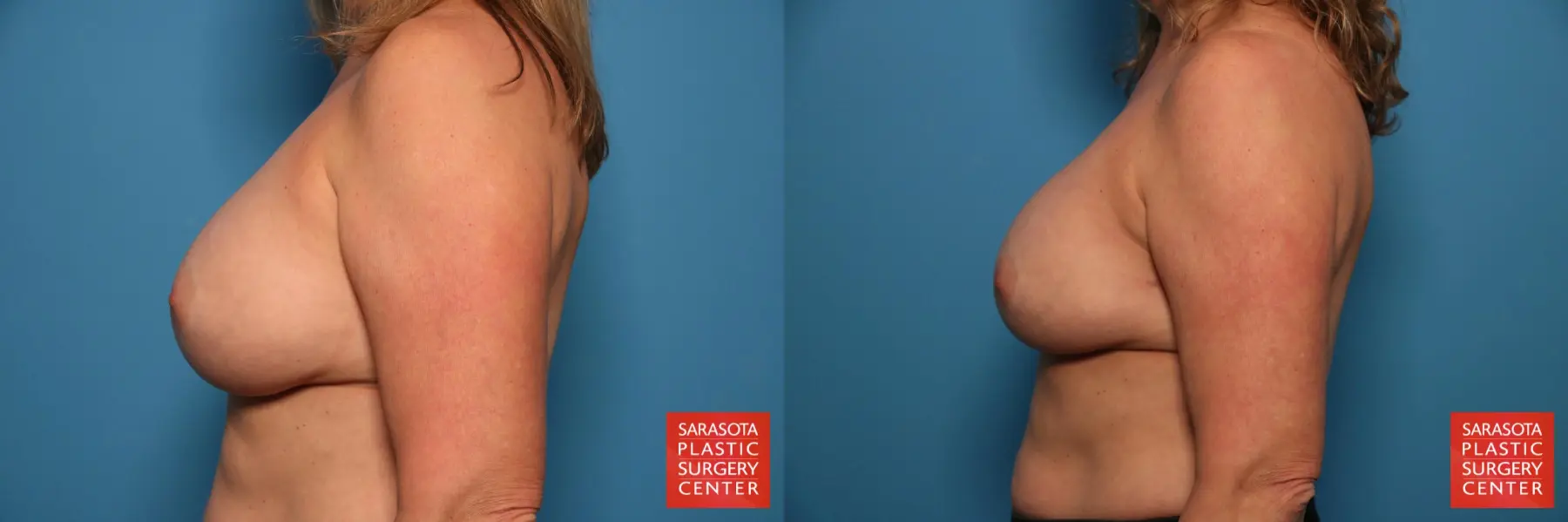 Breast Implant Exchange: Patient 14 - Before and After 3
