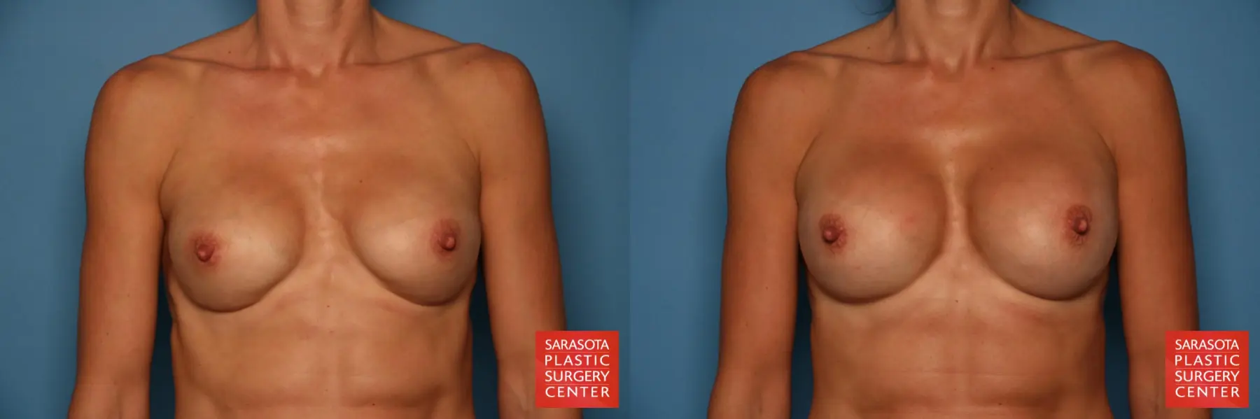 Breast Implant Exchange: Patient 1 - Before and After  