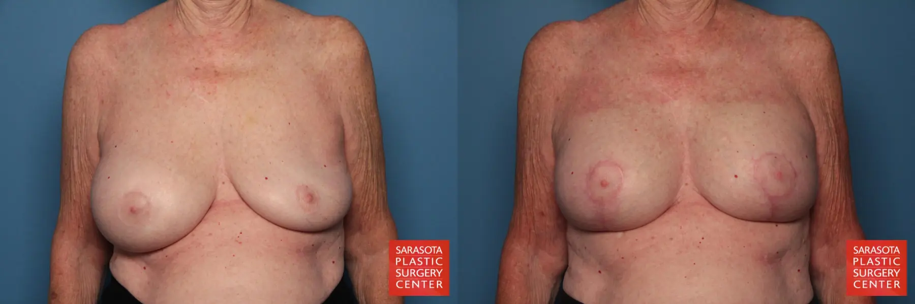 Breast Implant Exchange: Patient 7 - Before and After 1