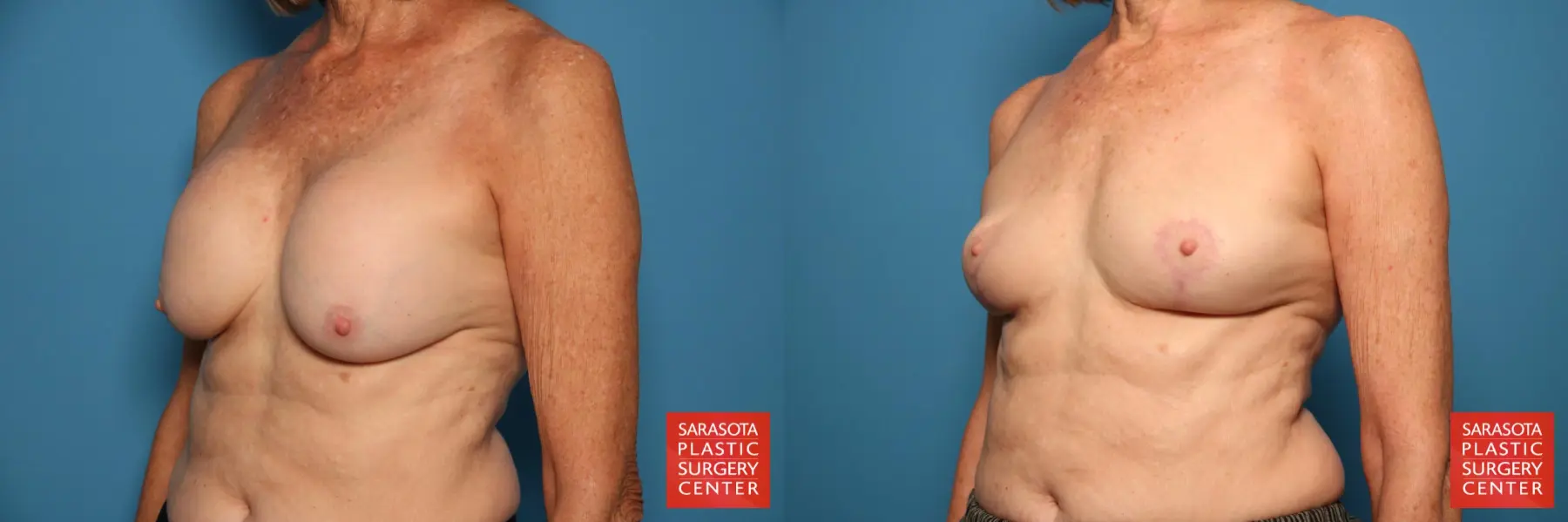 Breast Implant Removal With Lift: Patient 1 - Before and After 2