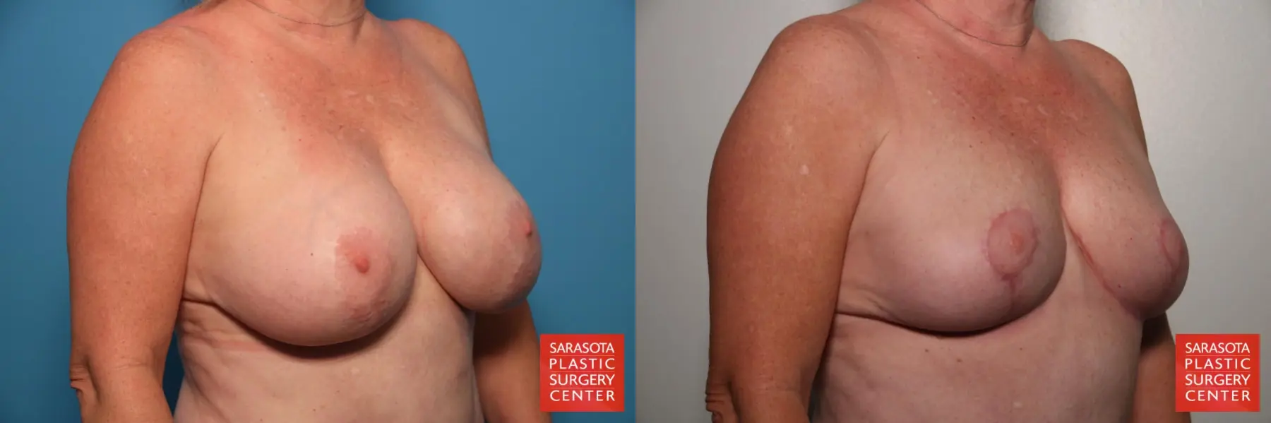 Breast Implant Removal With Lift: Patient 2 - Before and After 2