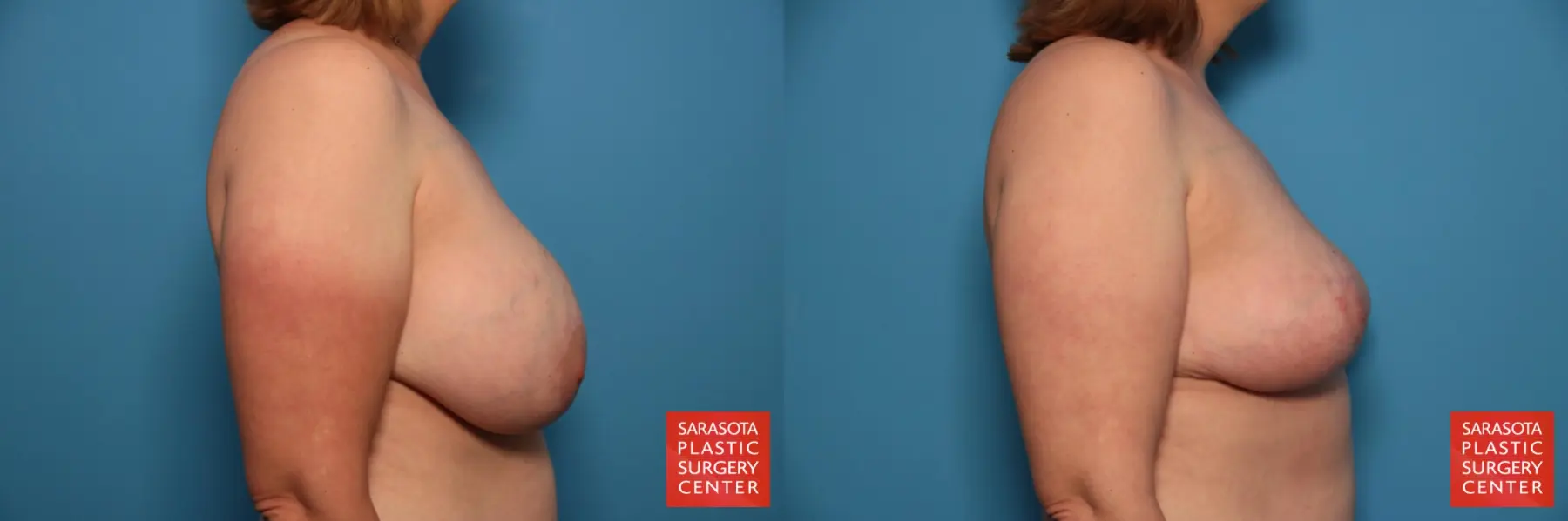 Breast Implant Removal With Lift: Patient 3 - Before and After 3