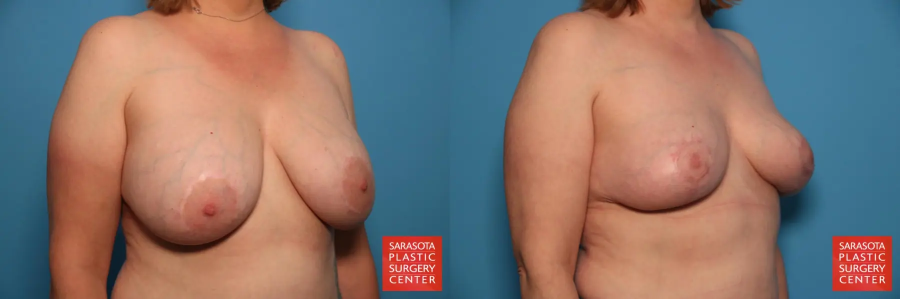 Breast Implant Removal With Lift: Patient 3 - Before and After 2