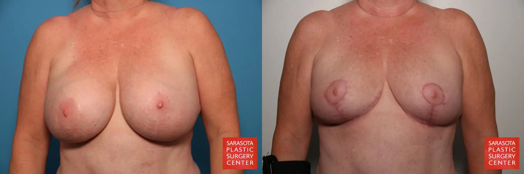 Breast Implant Removal With Lift: Patient 2 - Before and After 1