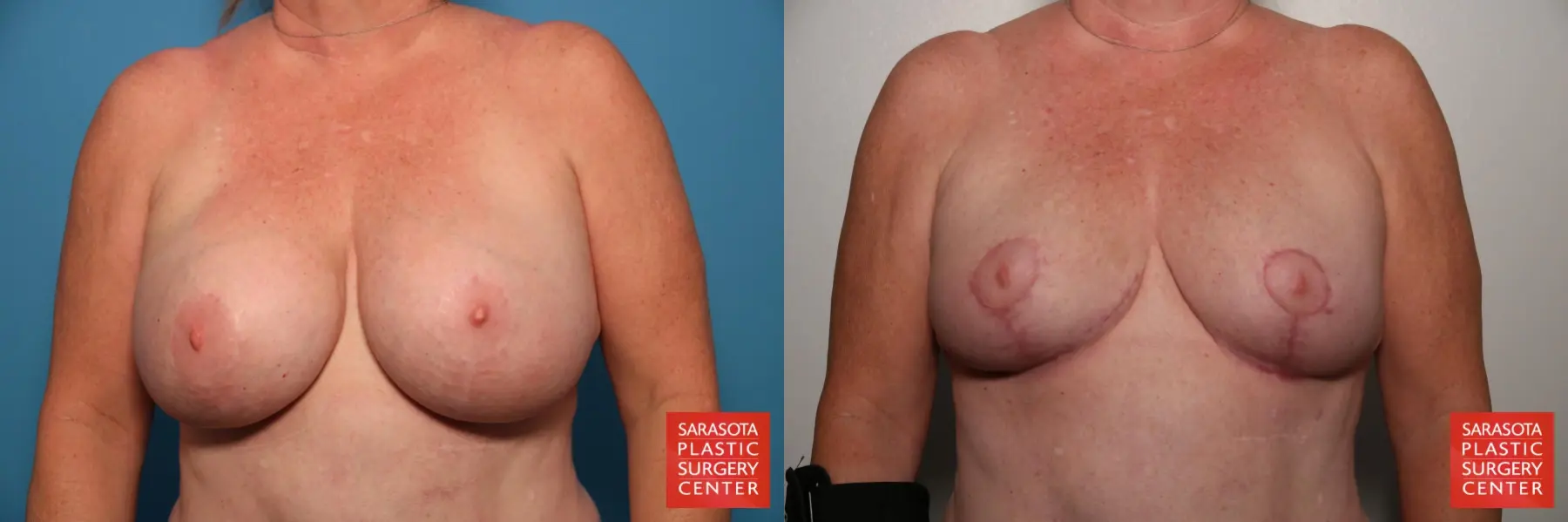 Breast Implant Removal With Lift: Patient 4 - Before and After  