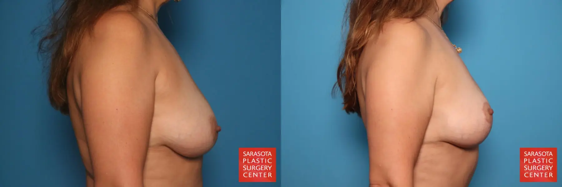 Breast Lift: Patient 3 - Before and After 3