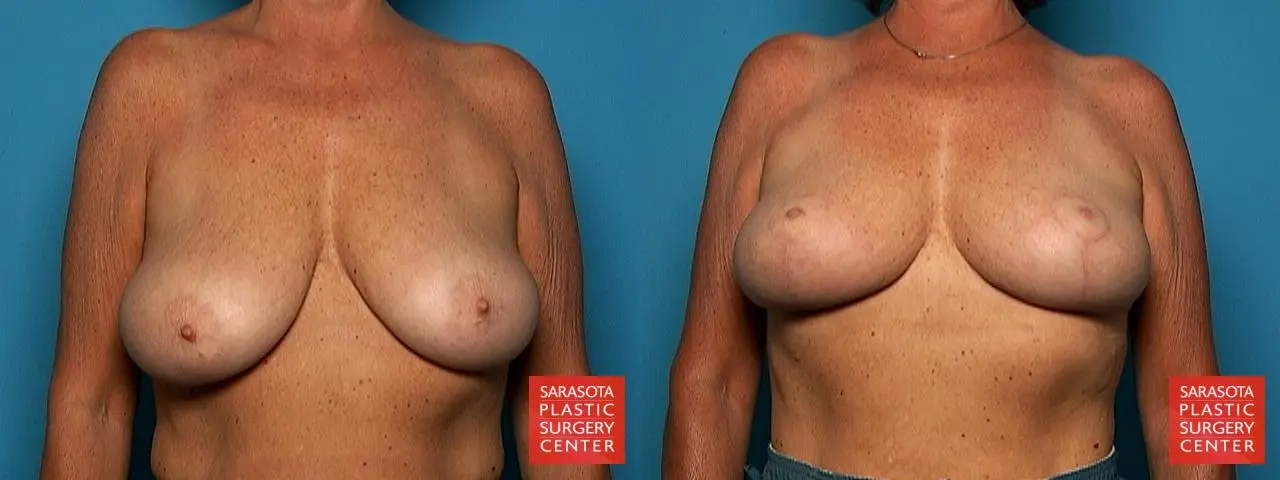 Breast Lift: Patient 6 - Before and After  