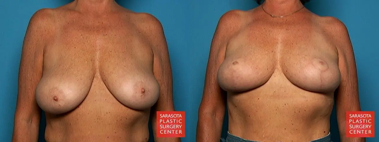 Breast Lift: Patient 1 - Before and After  