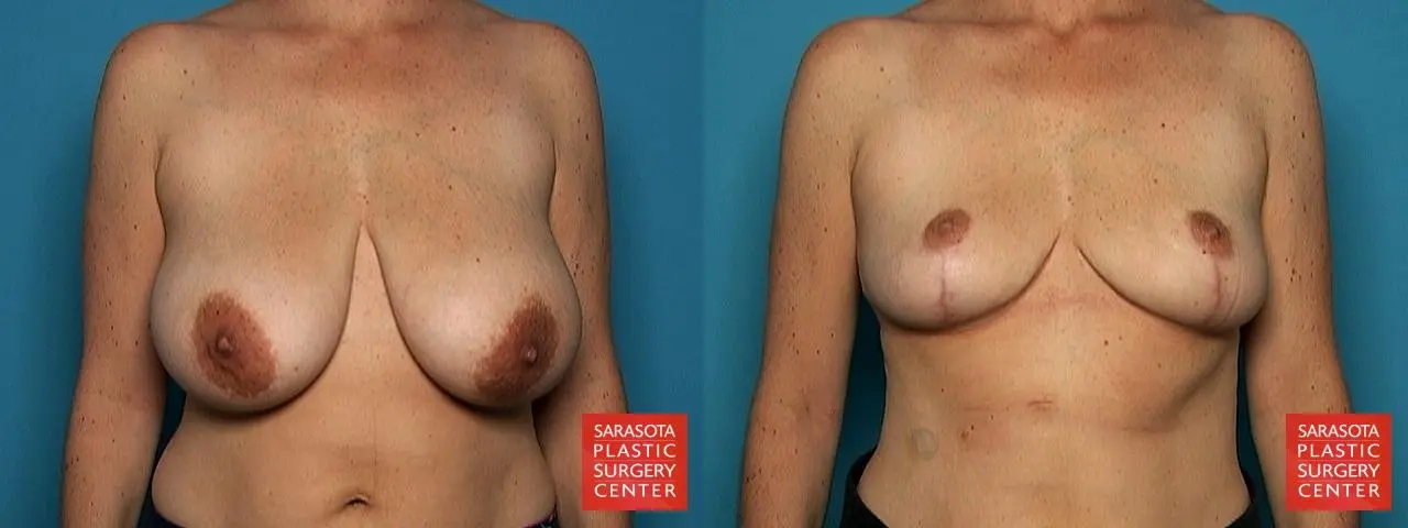 Breast Reduction: Patient 1 - Before and After  