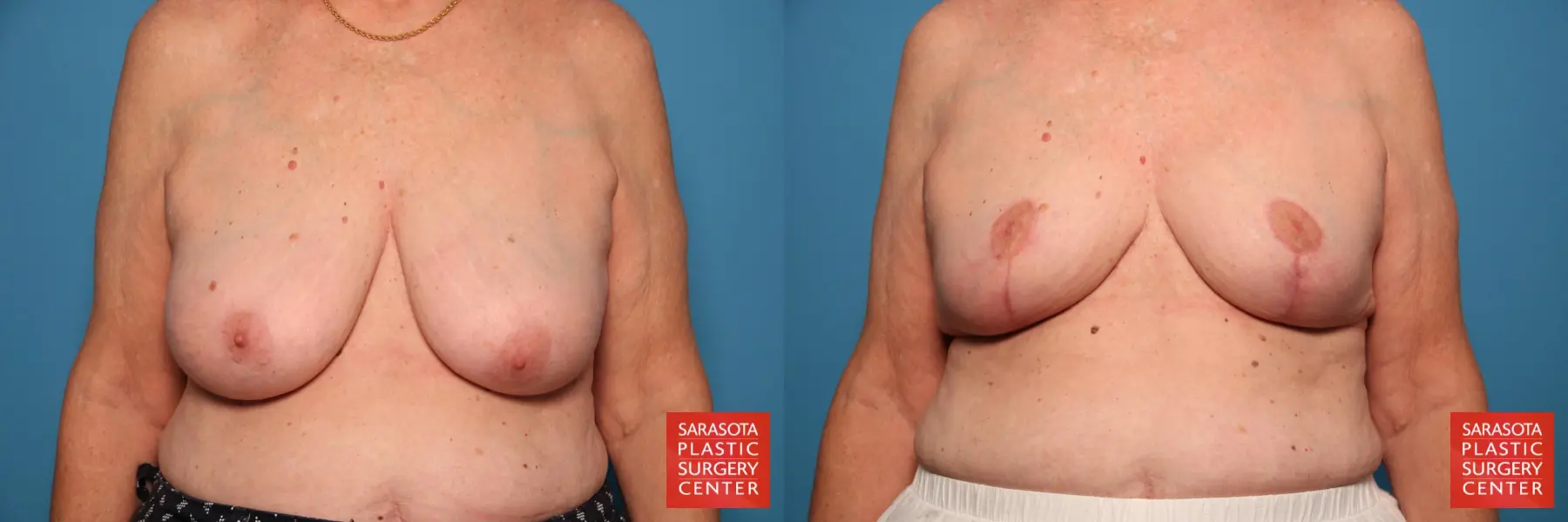 Breast Reduction: Patient 8 - Before and After  