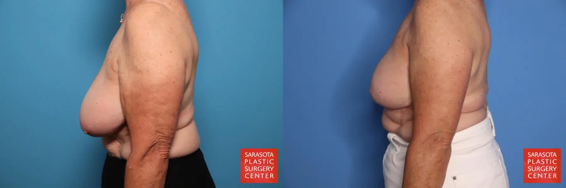 Breast Reduction: Patient 3 - Before and After 3