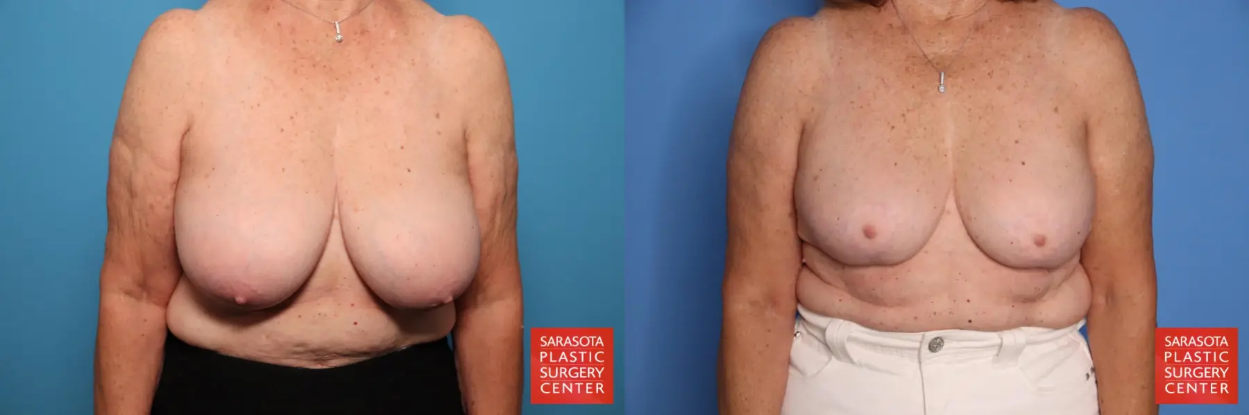 Breast Reduction: Patient 3 - Before and After 1