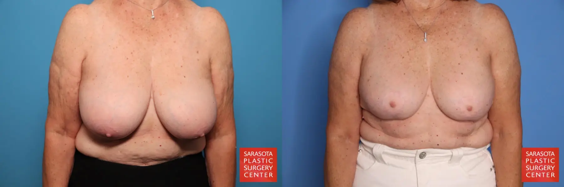 Breast Reduction: Patient 24 - Before and After  