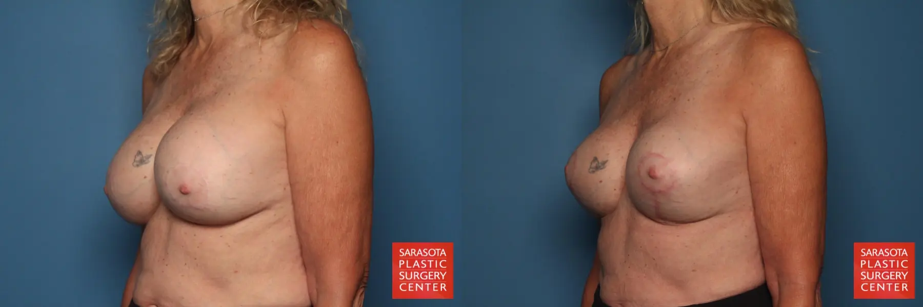 Breast Revision: Patient 4 - Before and After 2