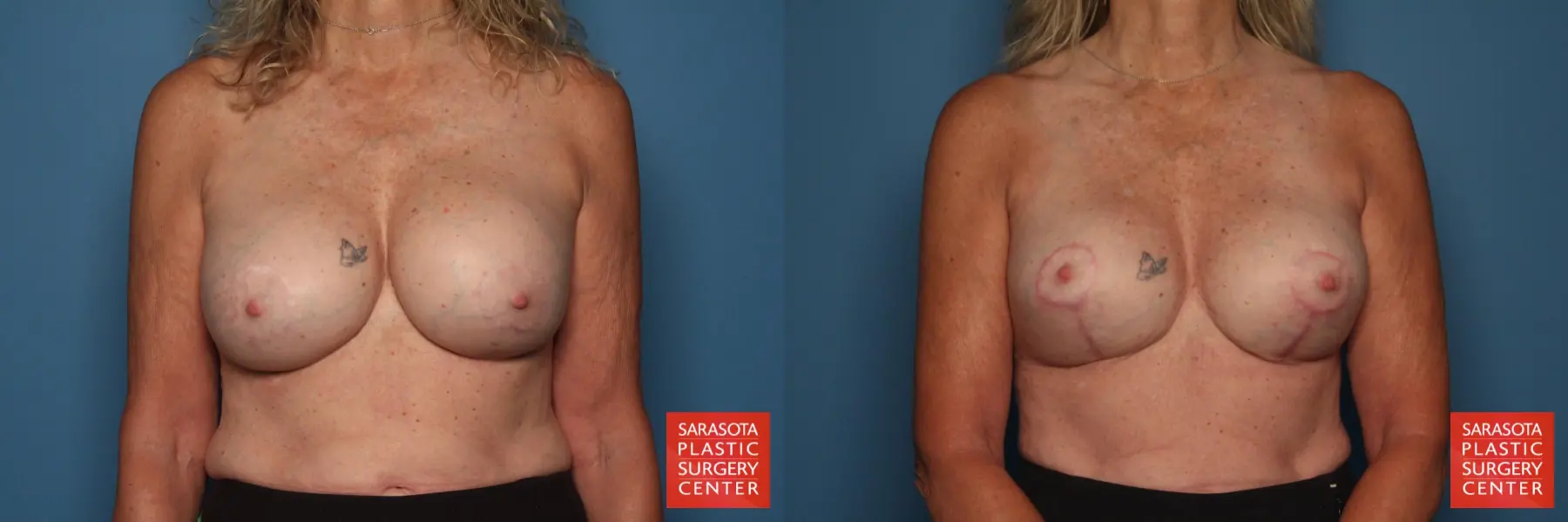 Breast Revision: Patient 4 - Before and After 1