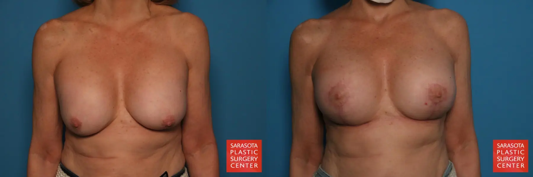 Breast Revision: Patient 15 - Before and After 1