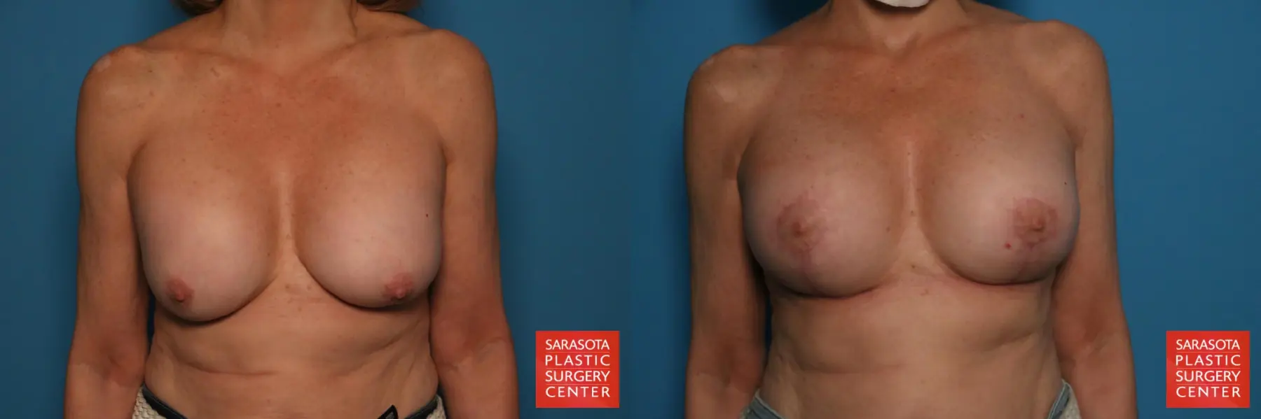 Breast Revision: Patient 15 - Before and After  