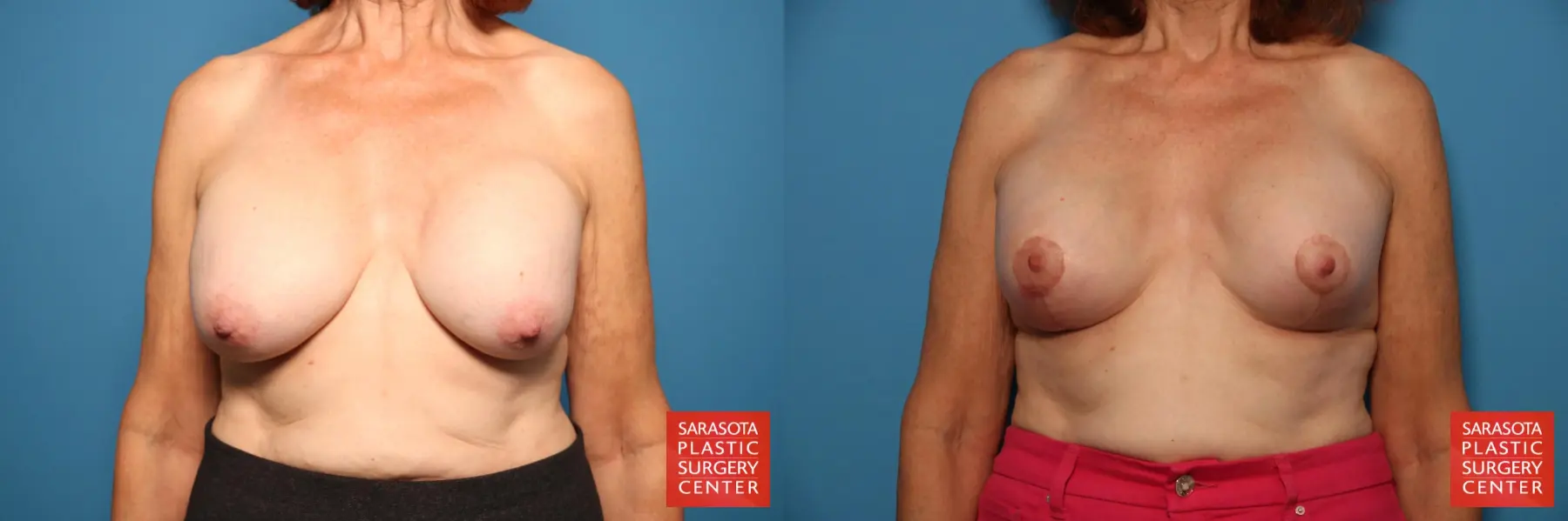 Breast Revision: Patient 10 - Before and After  