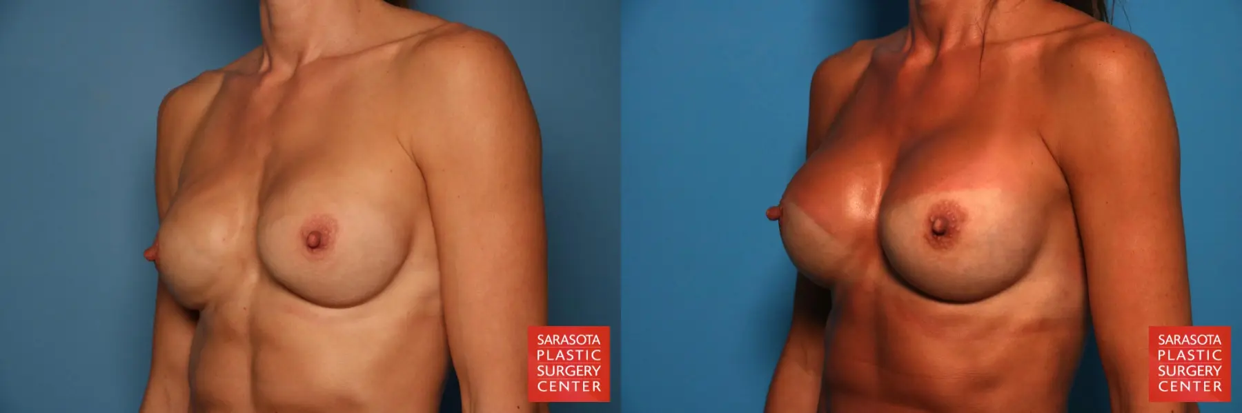 Breast Revision: Patient 8 - Before and After 2