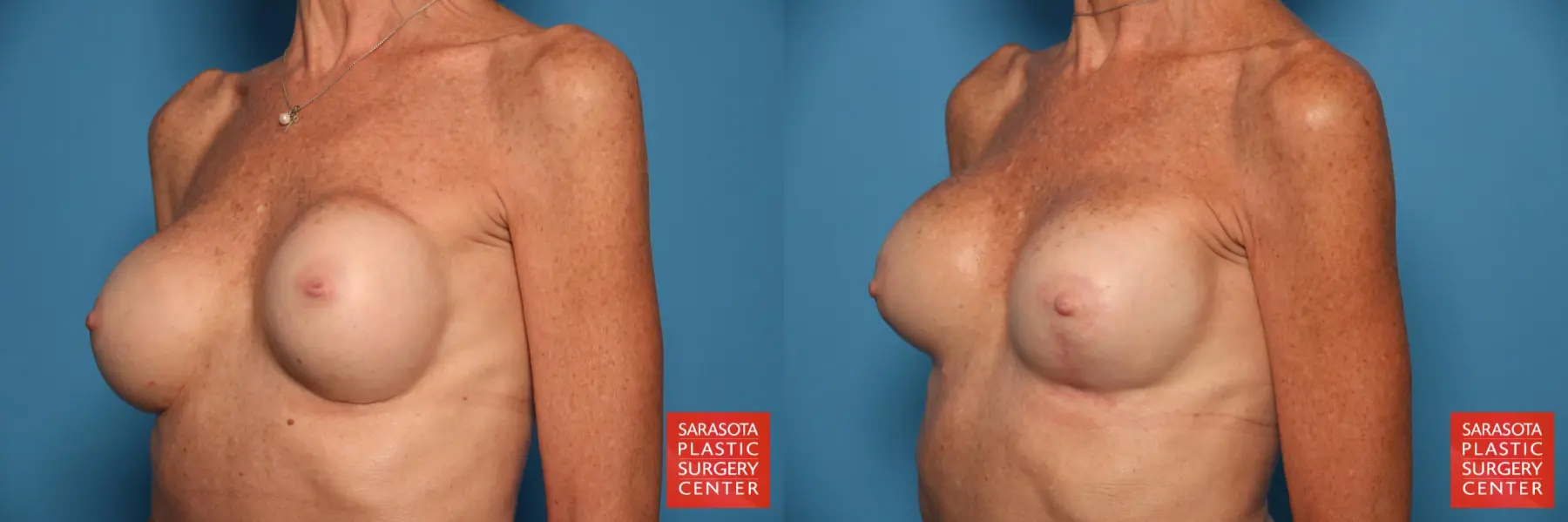 Breast Revision: Patient 6 - Before and After 2