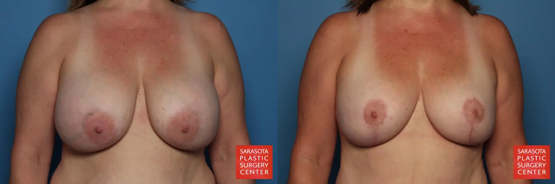 Breast Revision: Patient 11 - Before and After 1