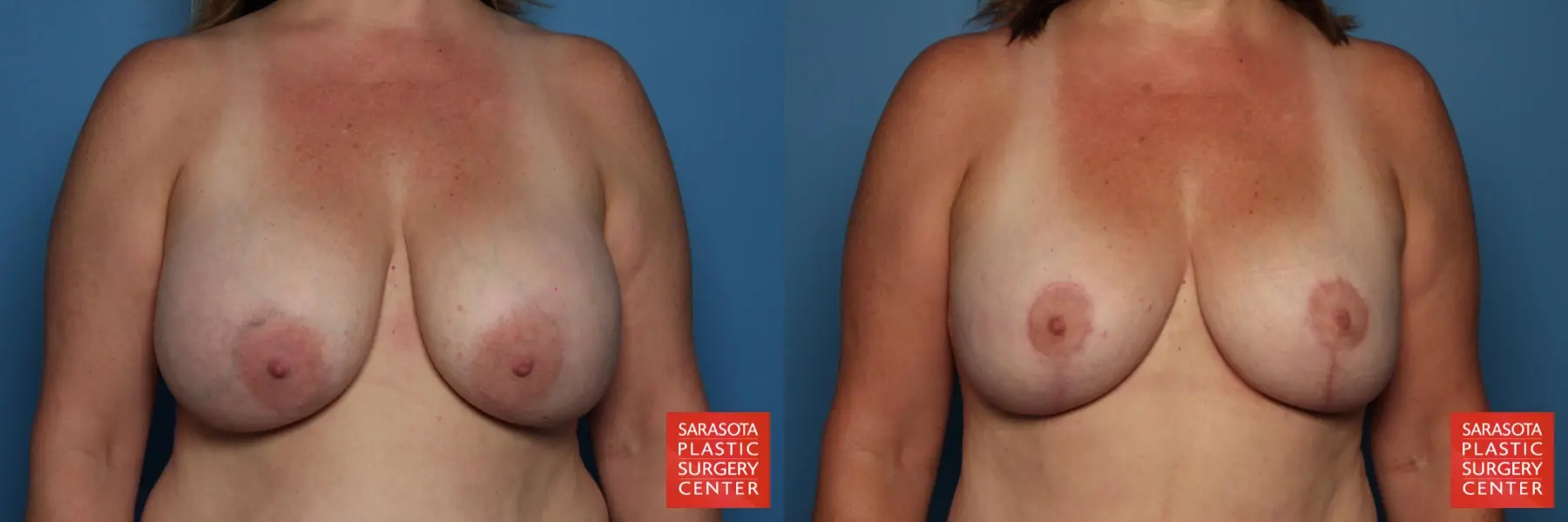 Breast Revision: Patient 12 - Before and After  