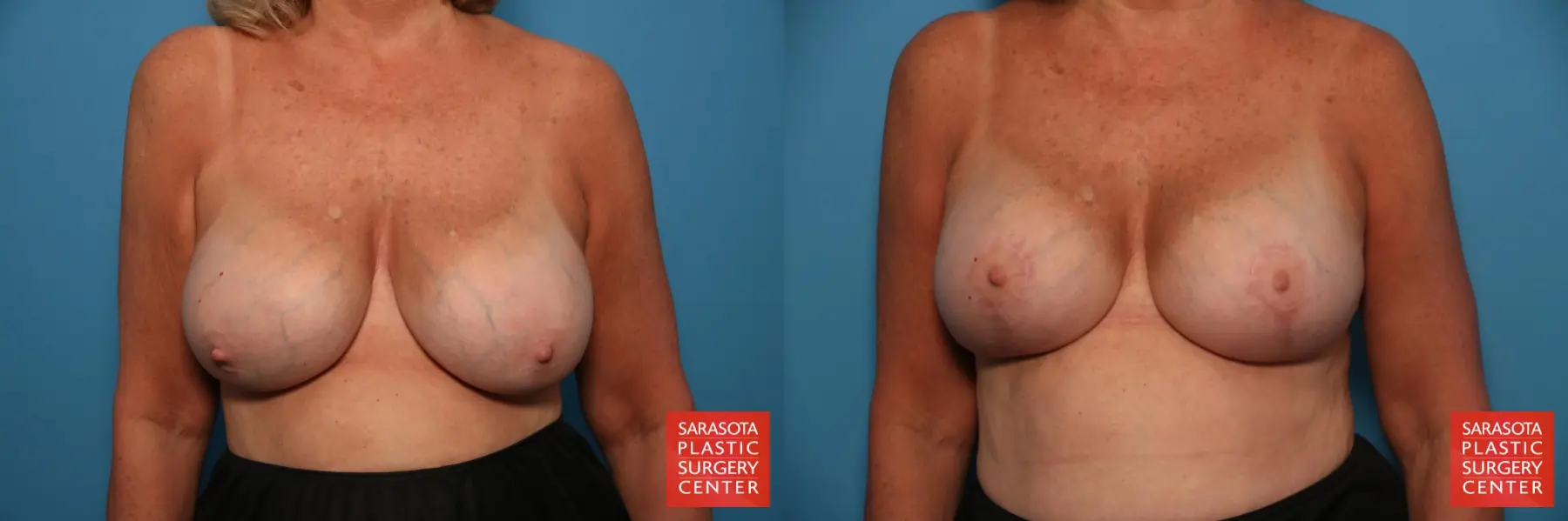 Breast Revision: Patient 2 - Before and After 1