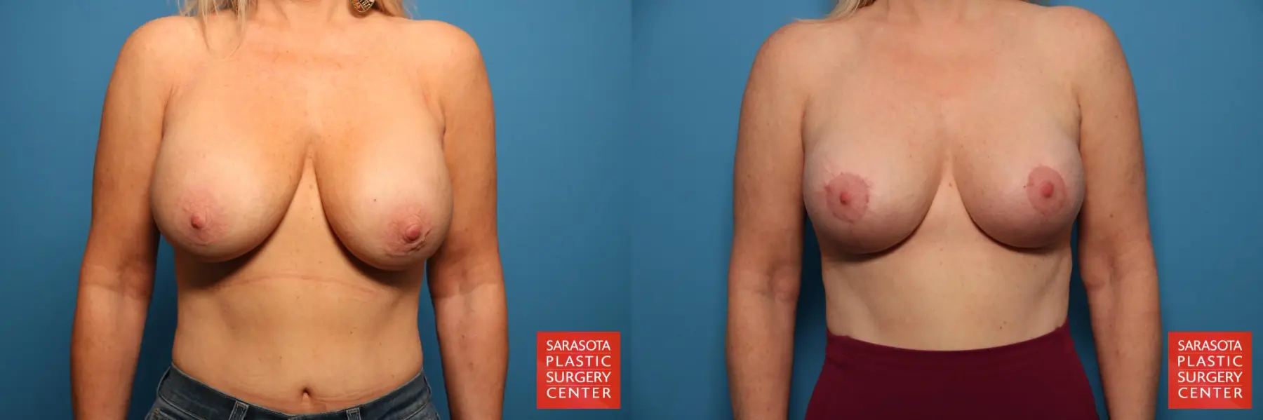 Breast Revision: Patient 1 - Before and After  