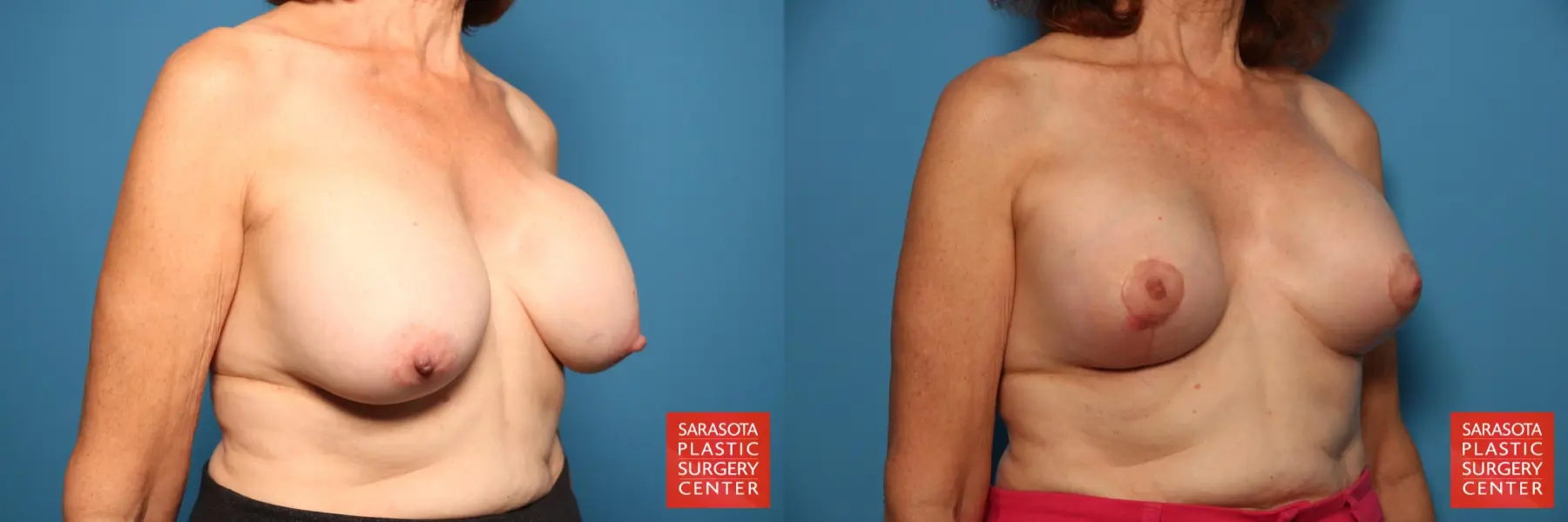 Breast Revision: Patient 9 - Before and After 2