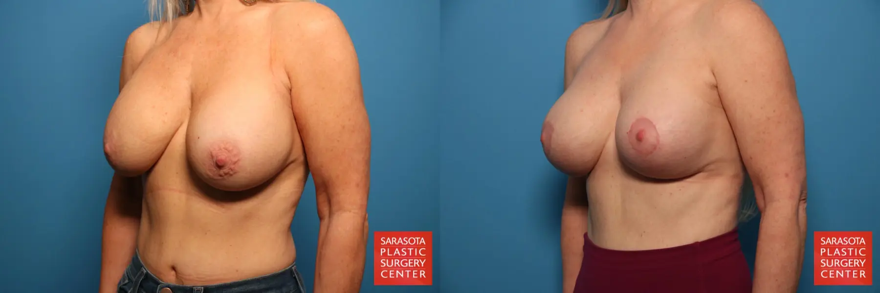 Breast Revision: Patient 1 - Before and After 2